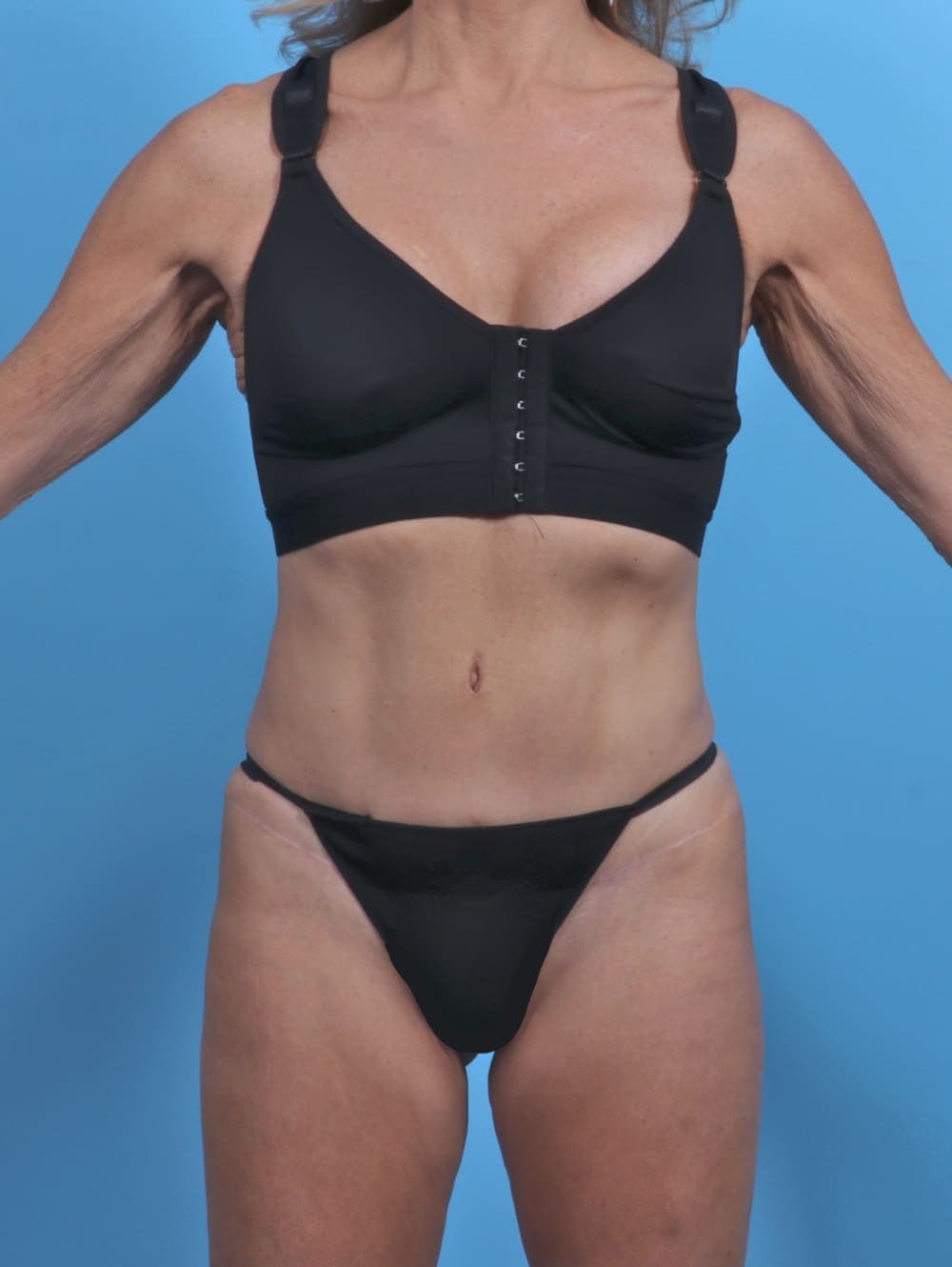 Tummy Tuck case #3933 after, image 1