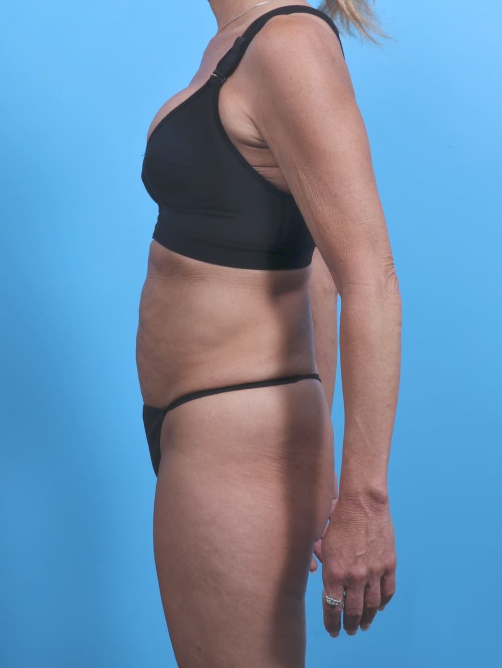 Tummy Tuck case #3933 before, image 3