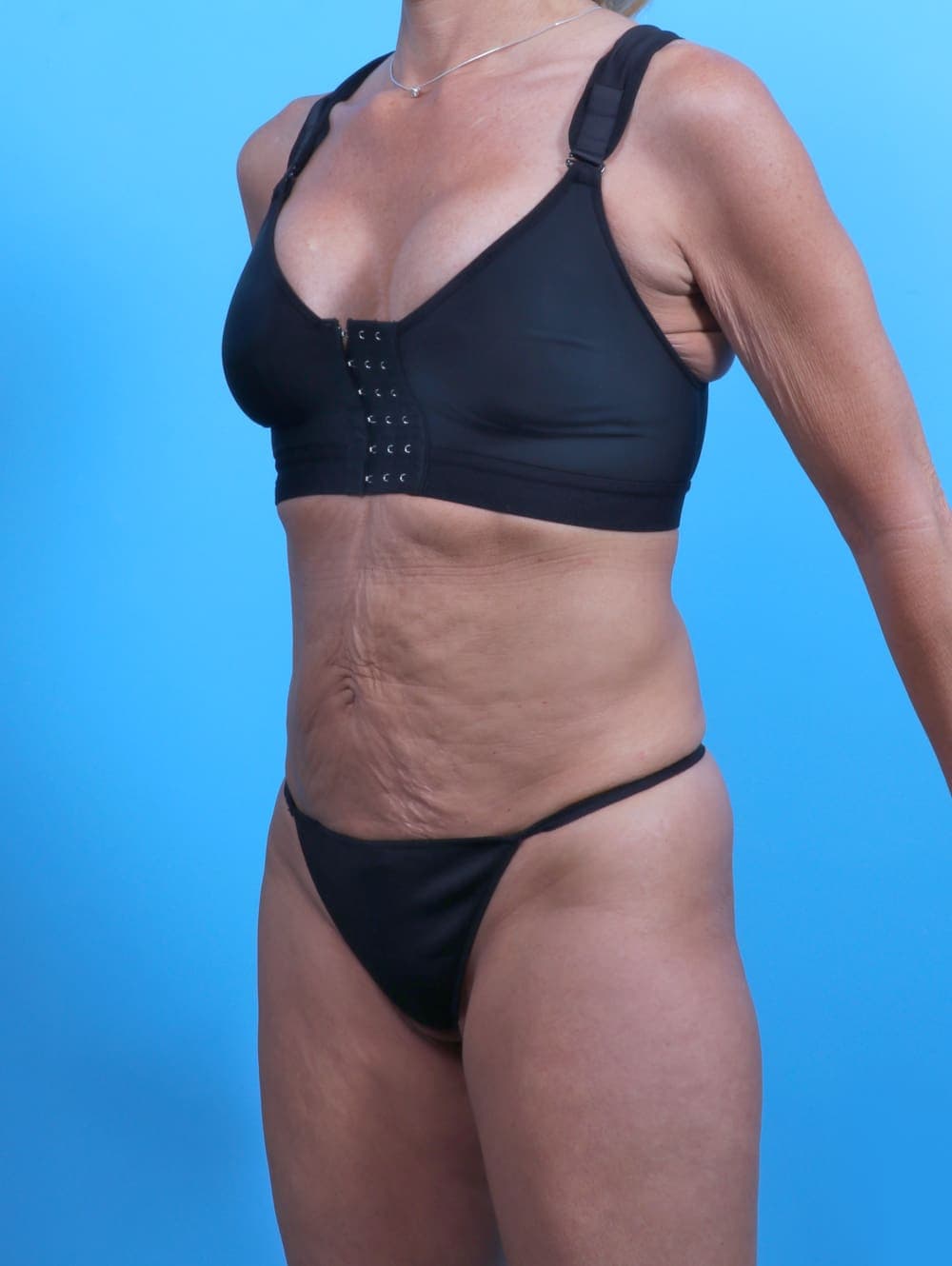 Tummy Tuck case #3933 before, image 2