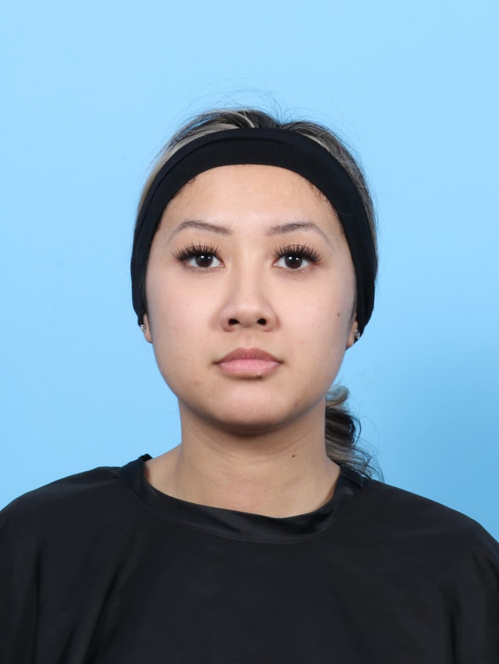 Rhinoplasty case #7606 before, image 2