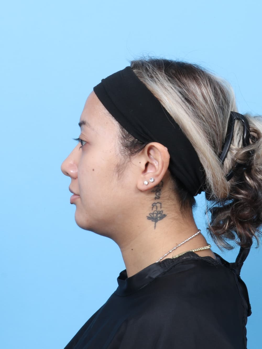 Rhinoplasty case #7606 after, image 1