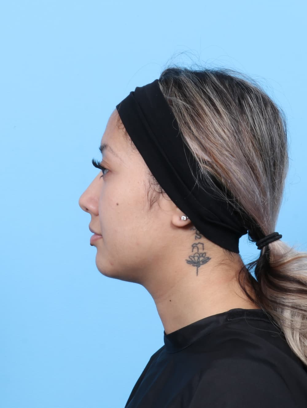 Rhinoplasty case #7606 before, image 1