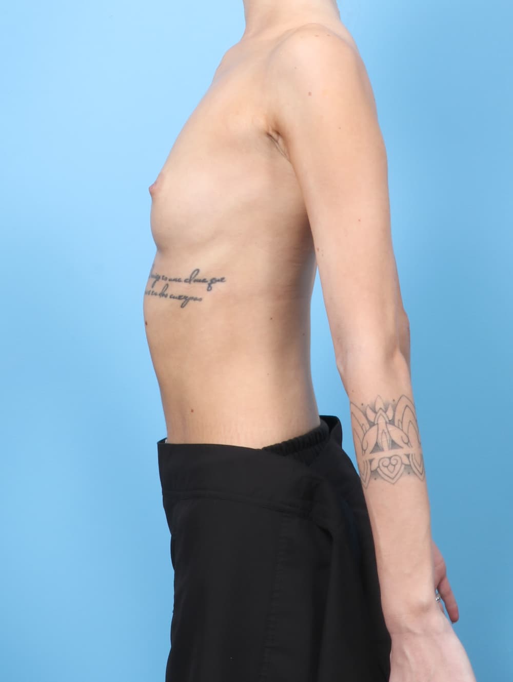 Breast Augmentation case #8570 before, image 3