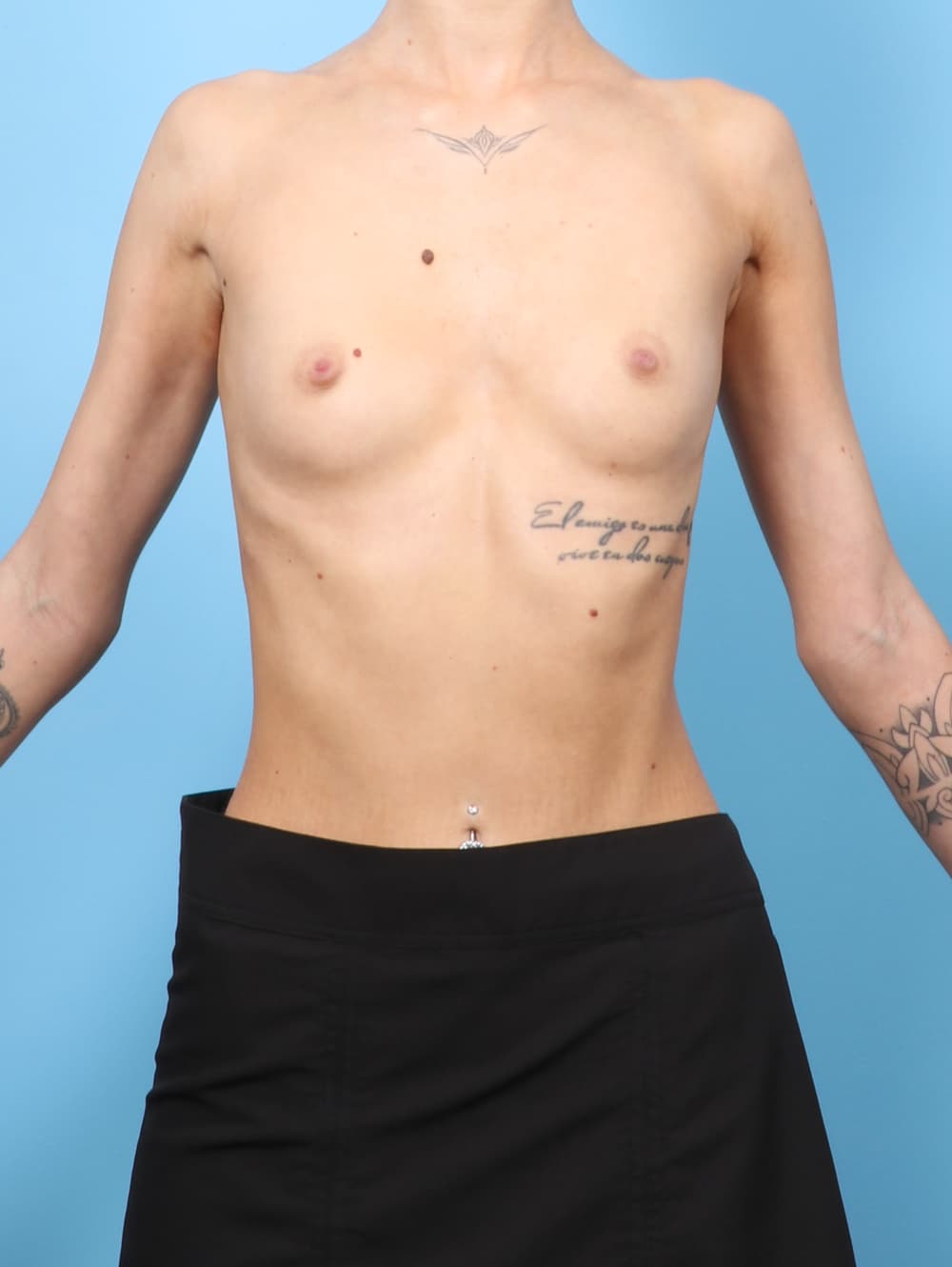 Breast Augmentation case #8570 before, image 1