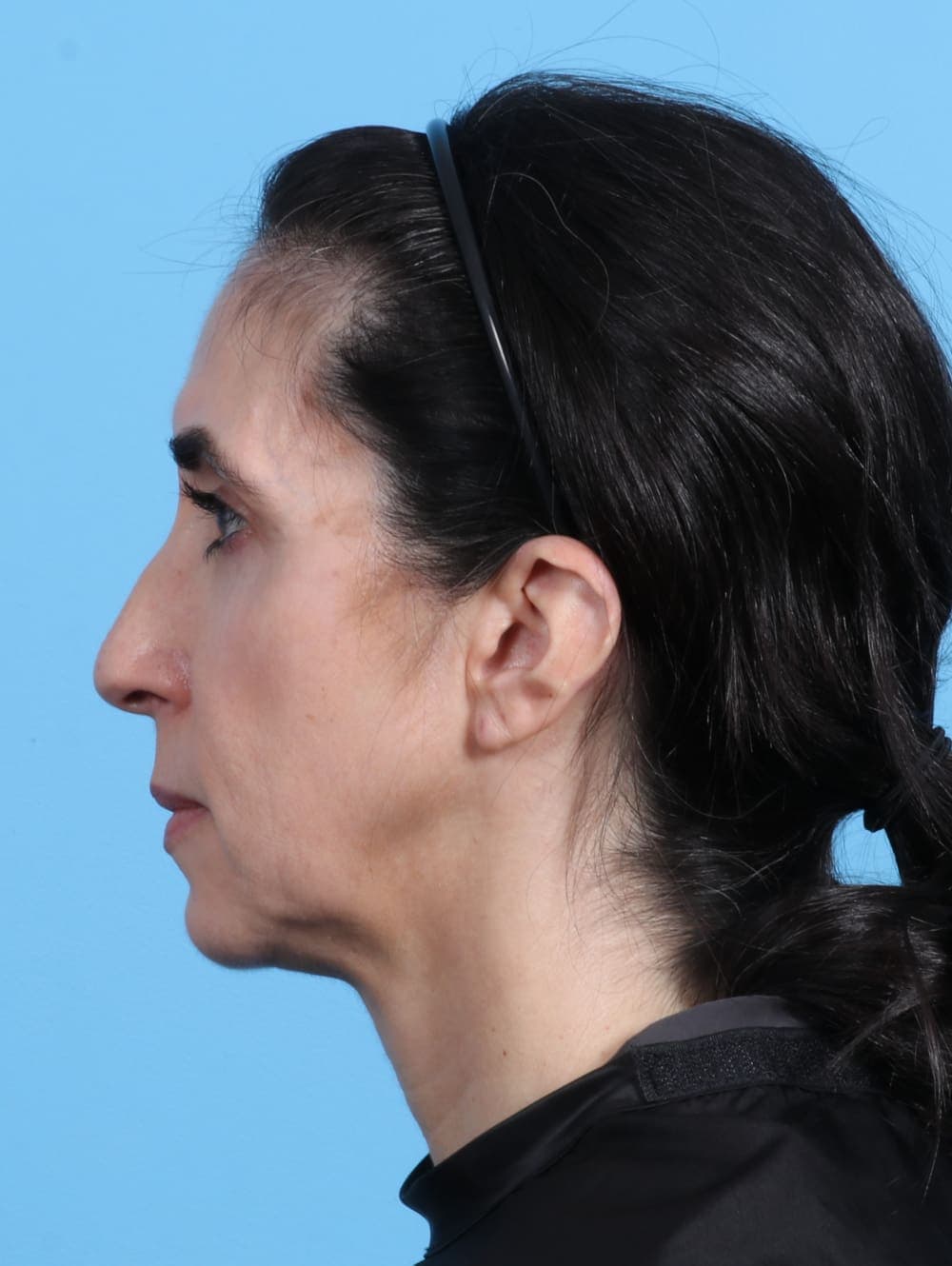 Eyelid Surgery case #2963 after, image 3