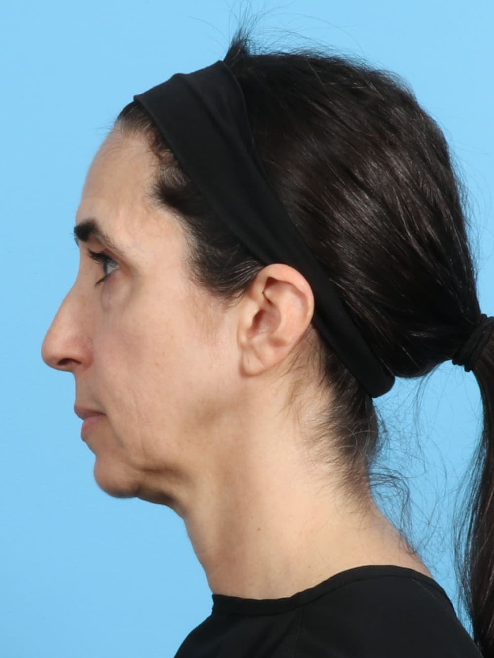 Eyelid Surgery case #2963 before, image 3
