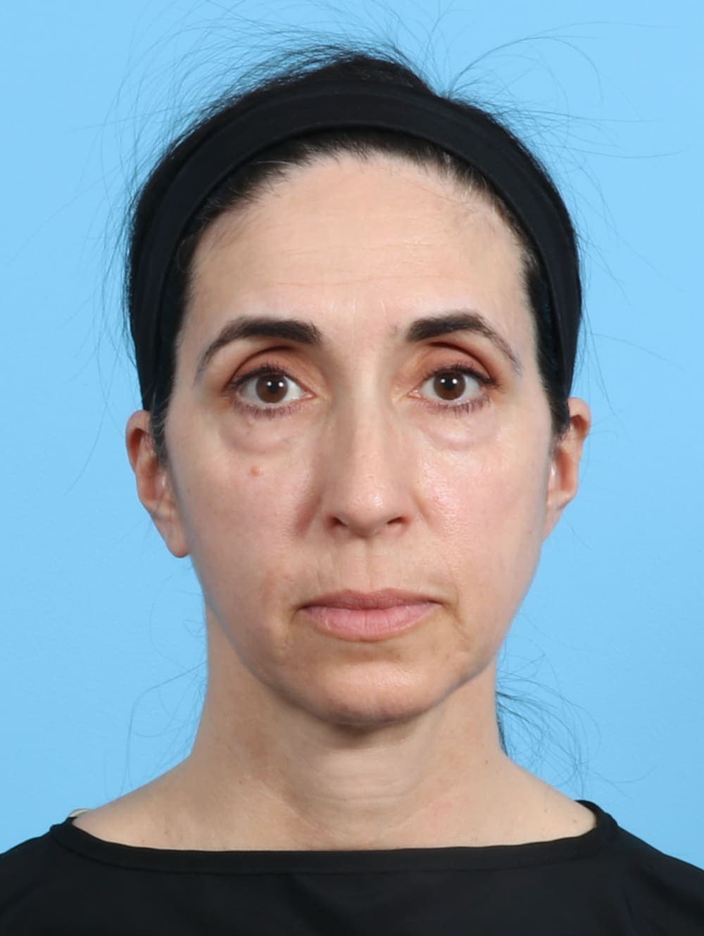 Eyelid Surgery case #2963 before, image 1