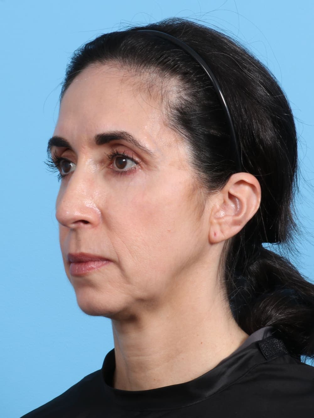 Eyelid Surgery case #2963 after, image 2