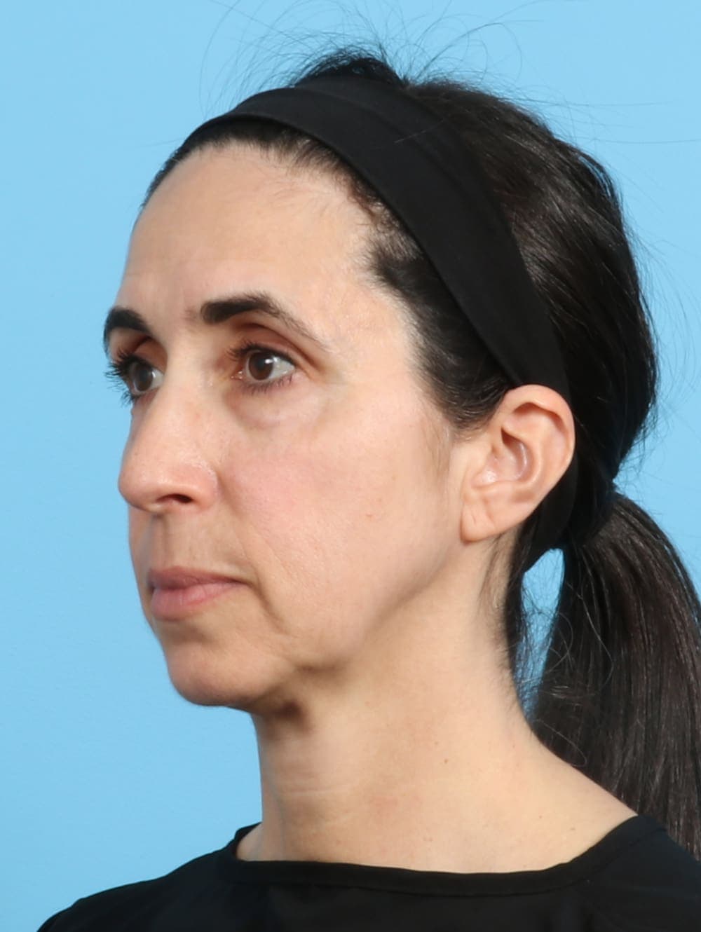 Eyelid Surgery case #2963 before, image 2