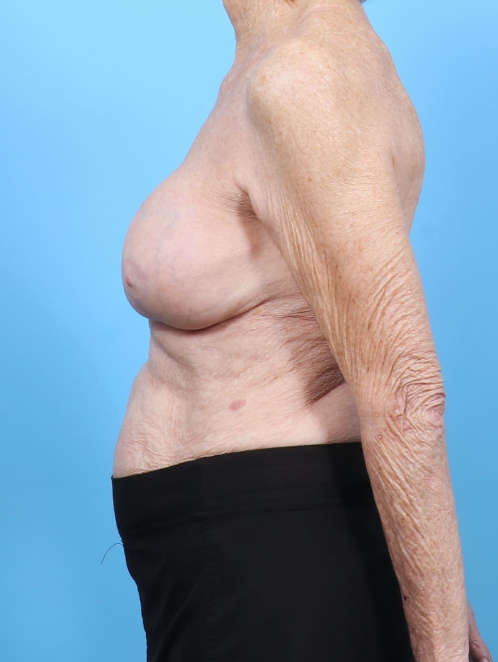Breast Implant Revision case #6515 after, image 3