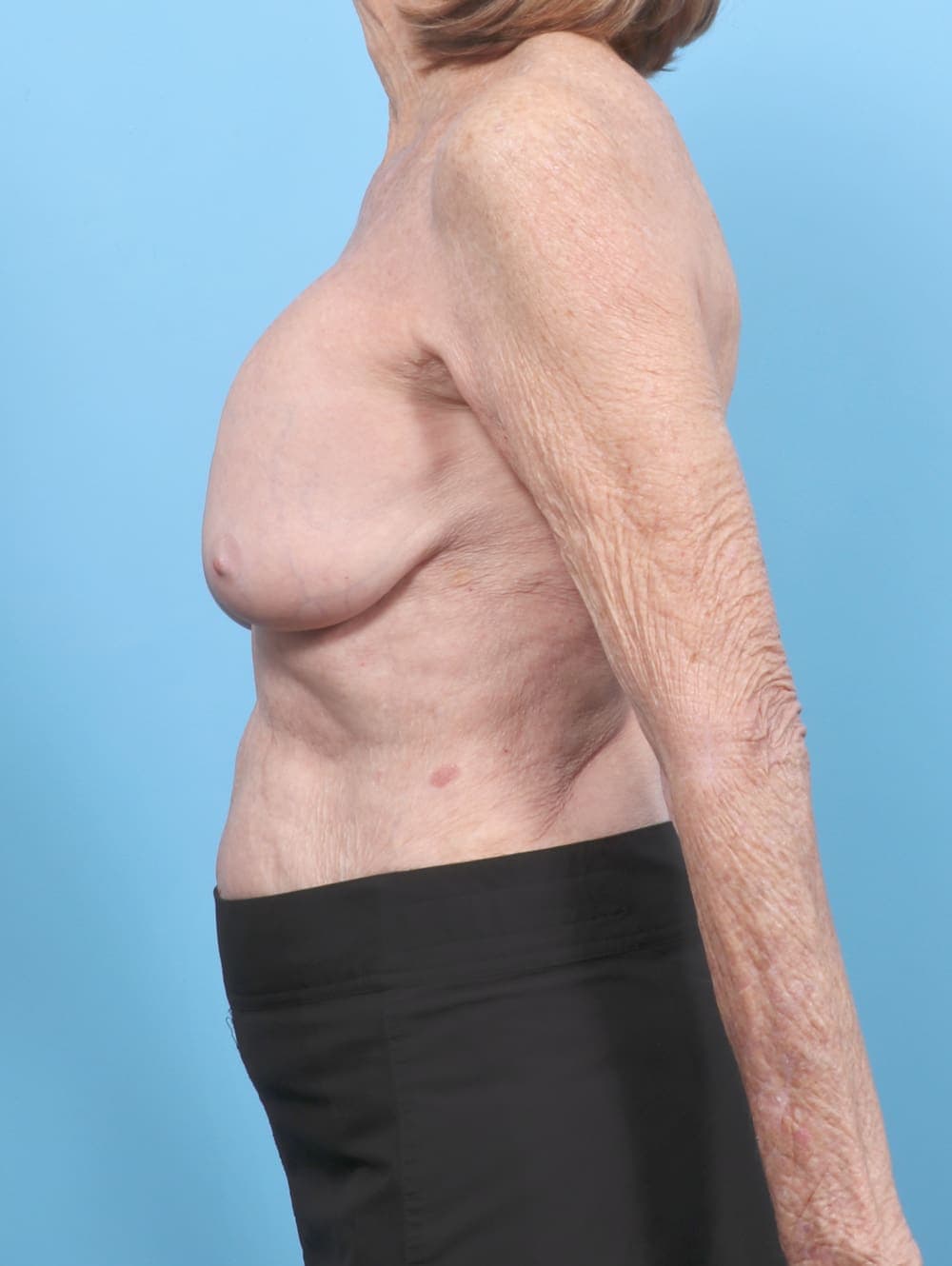 Breast Implant Revision case #6515 before, image 3