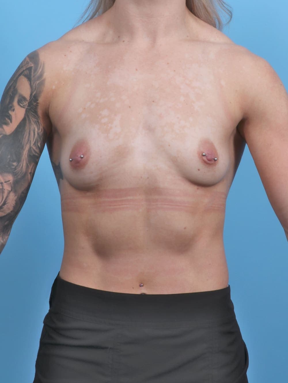 Breast Augmentation case #5309 before, image 1