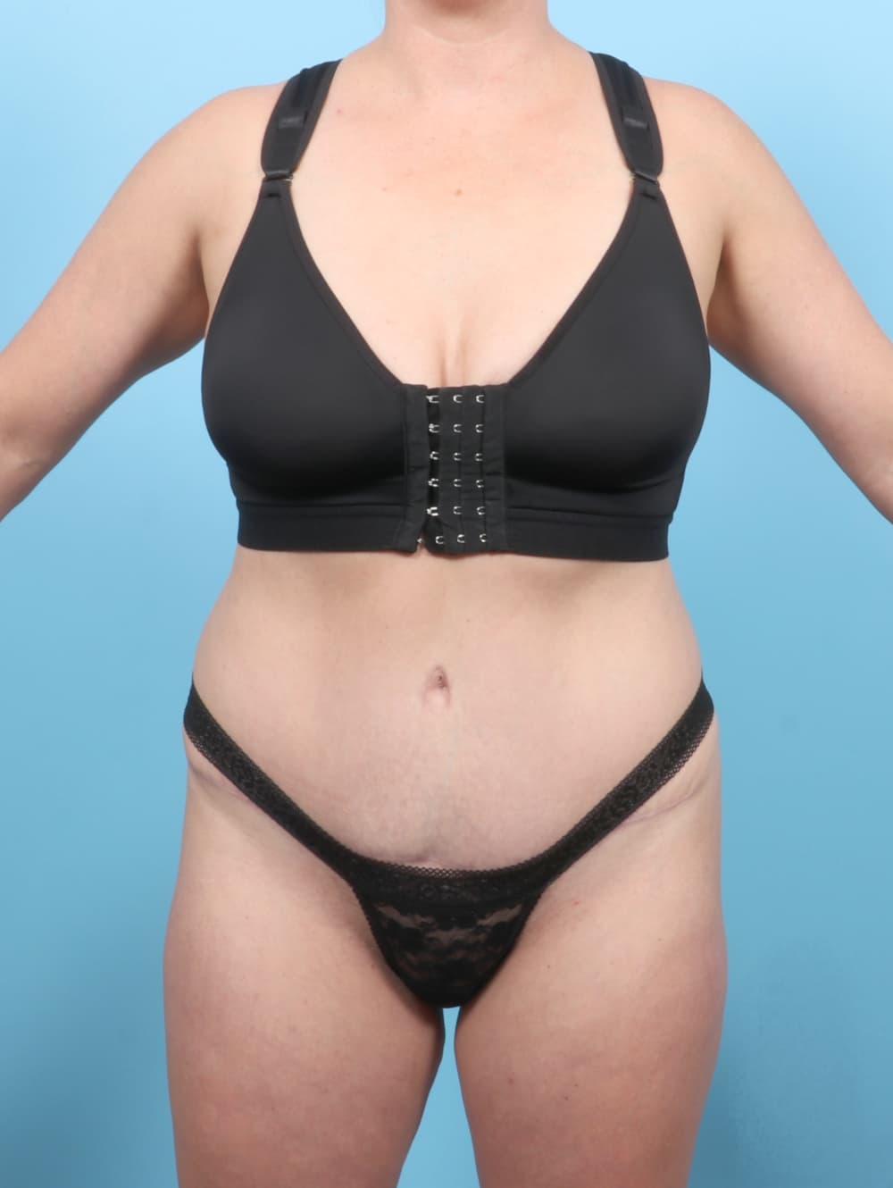 Tummy Tuck case #7016 after, image 1