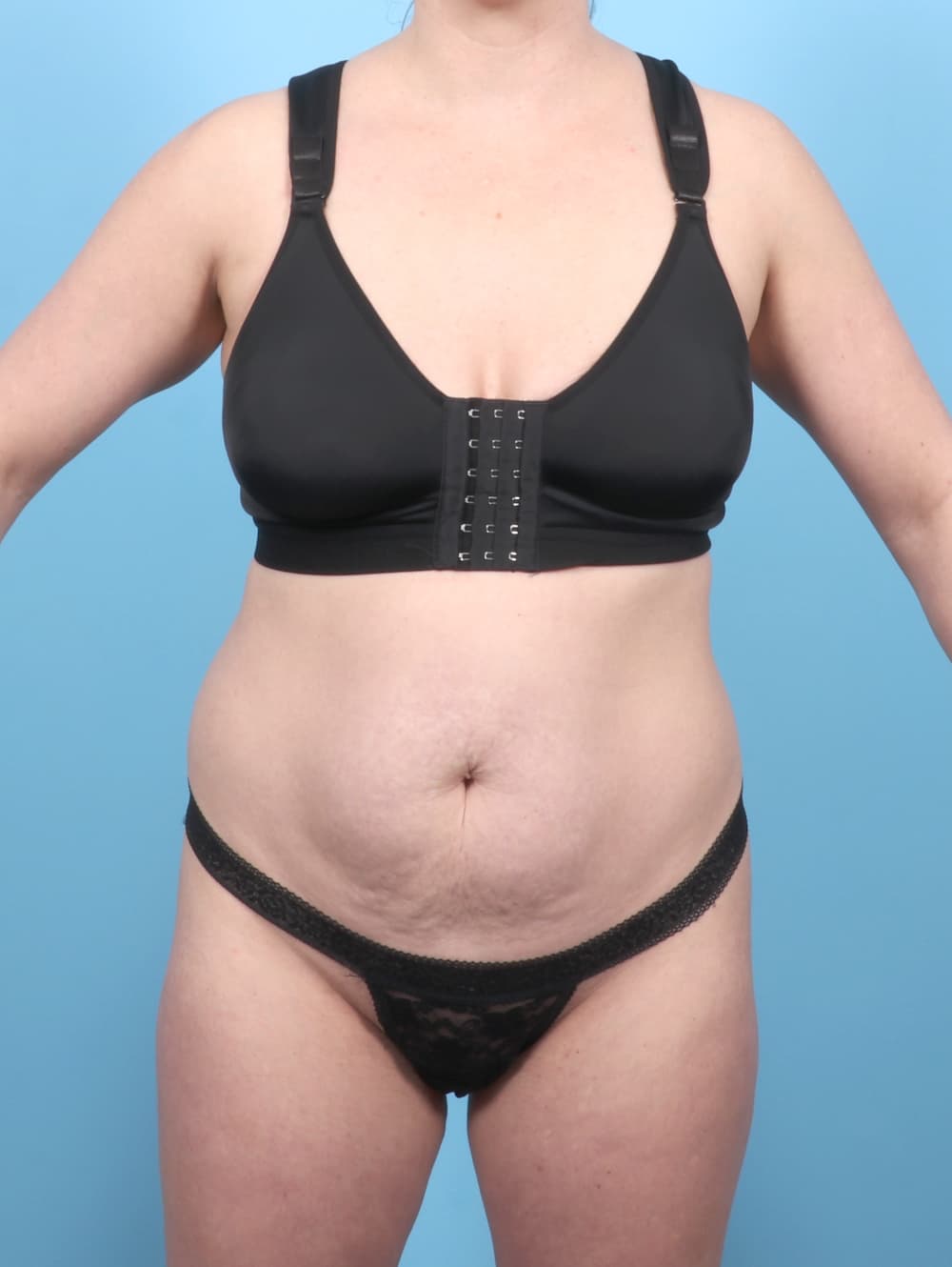Tummy Tuck case #7016 before, image 1