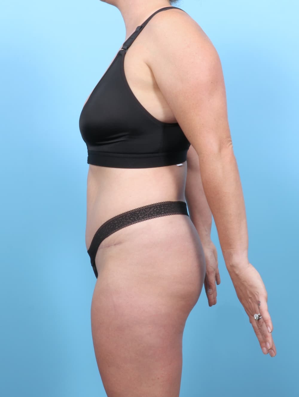 Tummy Tuck case #7016 after, image 3