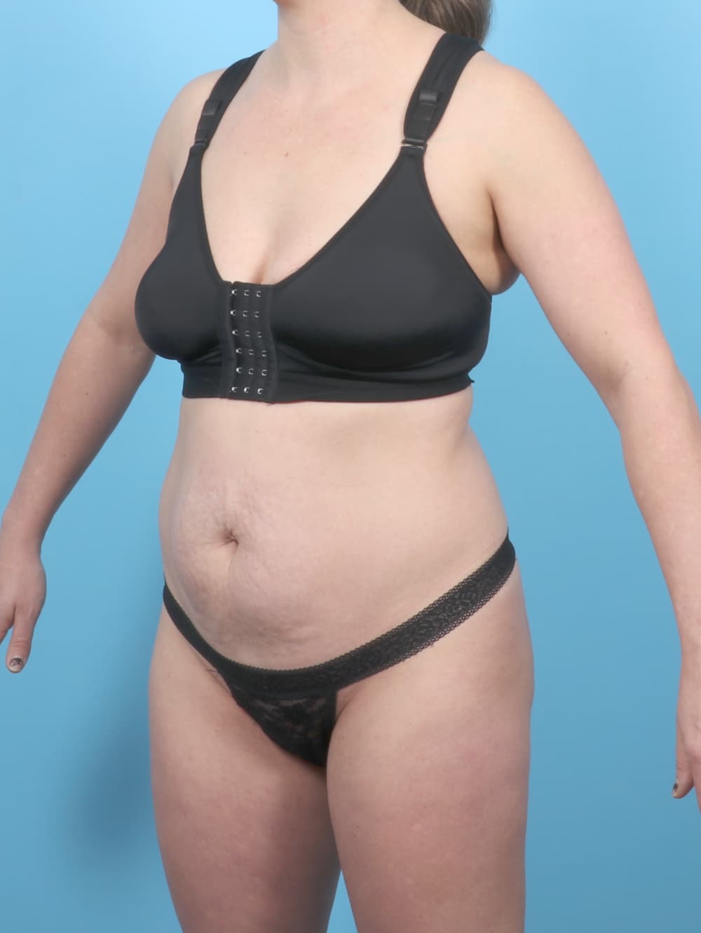 Tummy Tuck case #7016 before, image 2