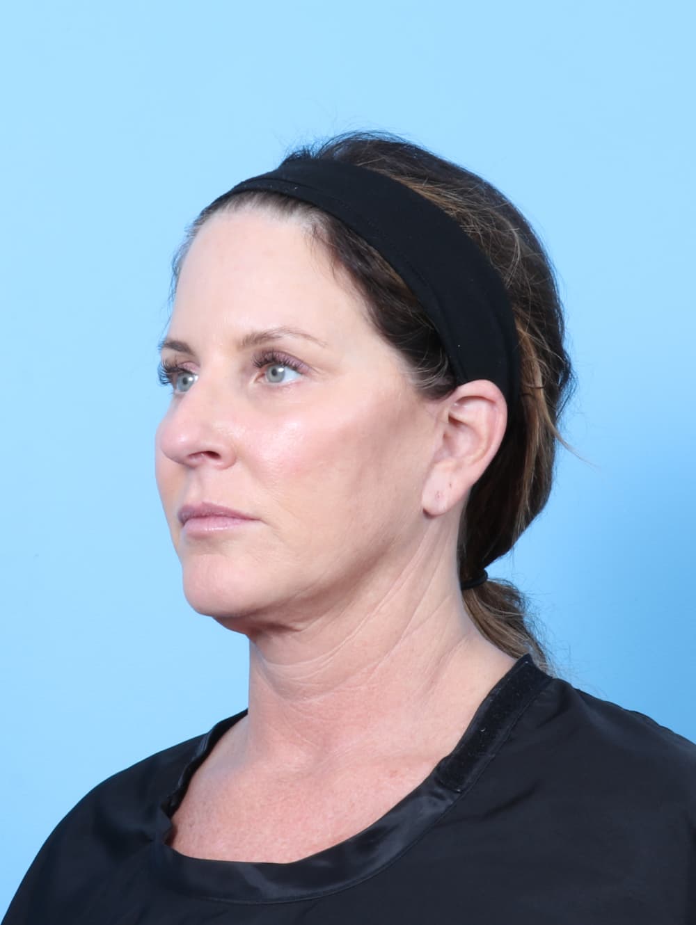 Facelift case #7622 after, image 3