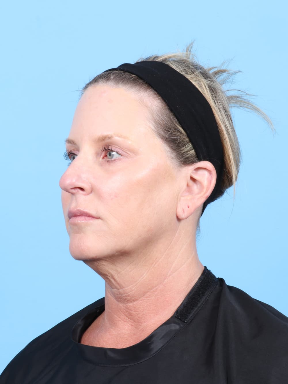 Facelift case #7622 before, image 3