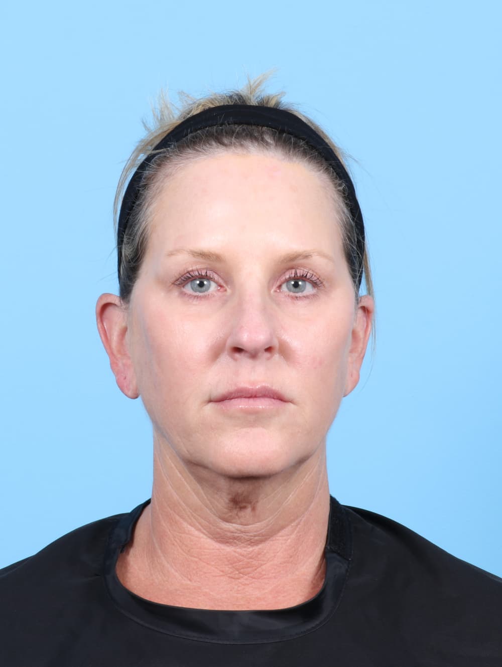 Facelift case #7622 before
