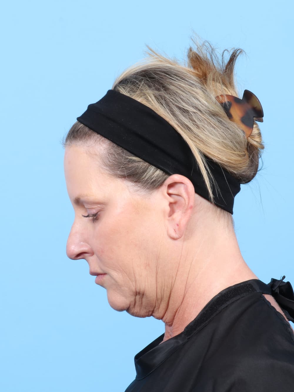 Facelift case #7622 before, image 2