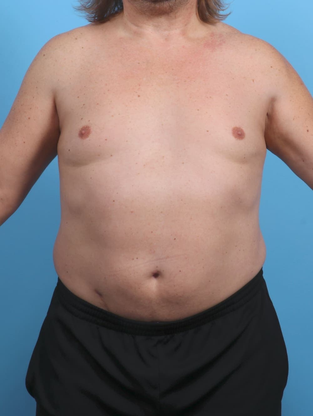 Liposuction case #4569 after, image 1