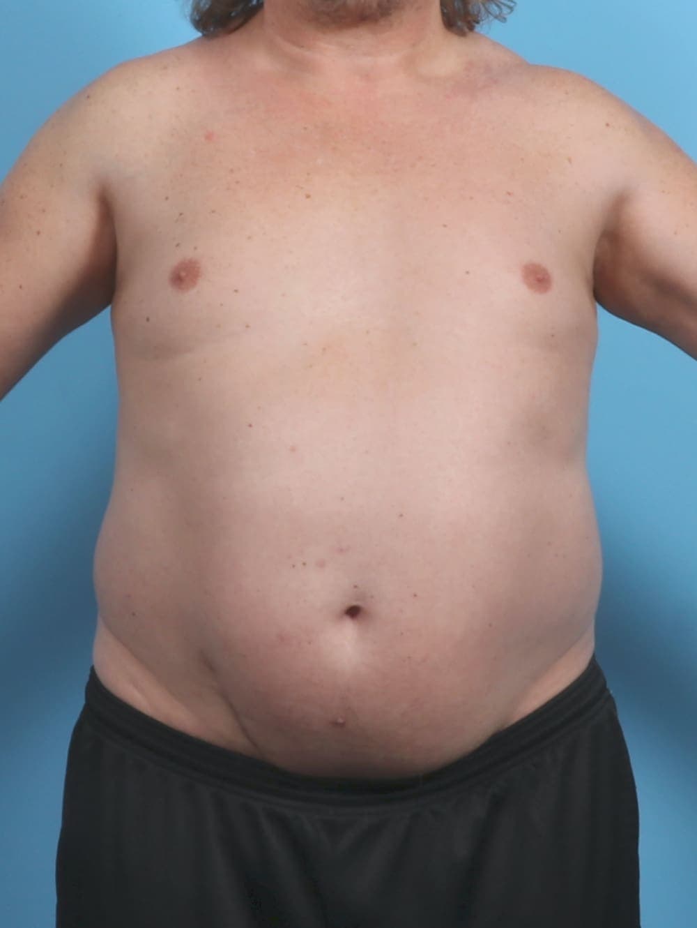 Liposuction case #4569 before, image 1