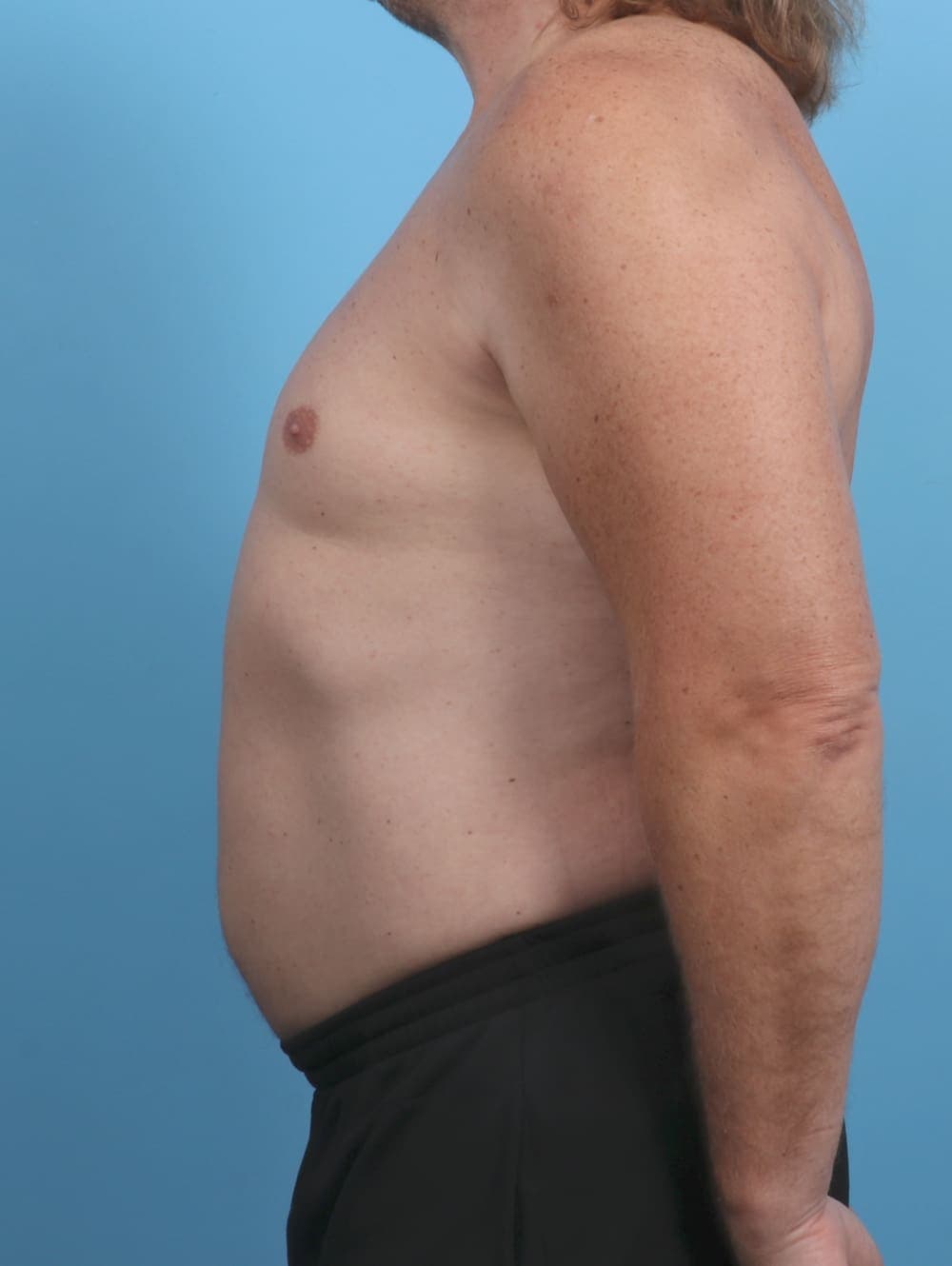 Liposuction case #4569 after, image 3