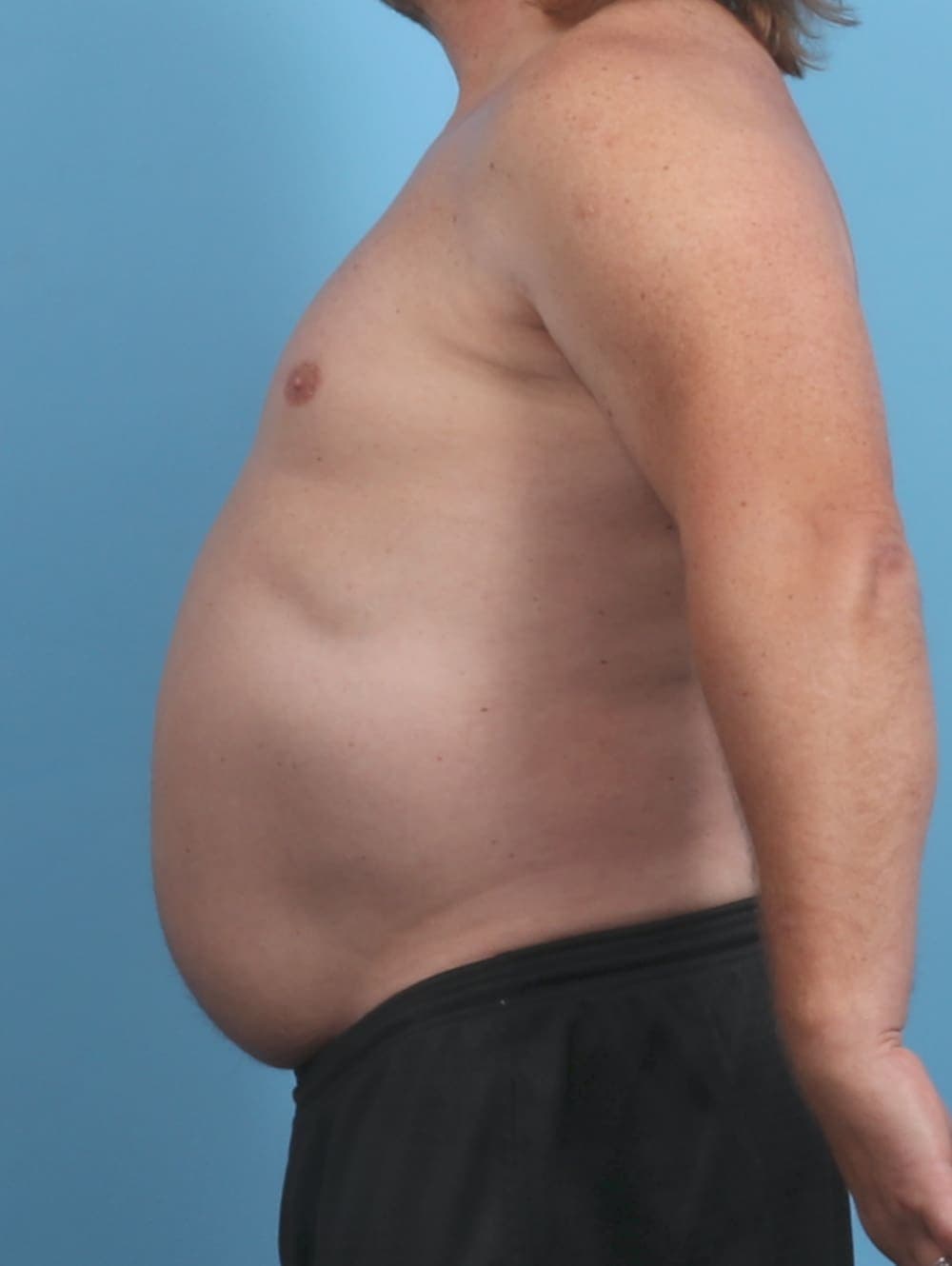 Liposuction case #4569 before, image 3