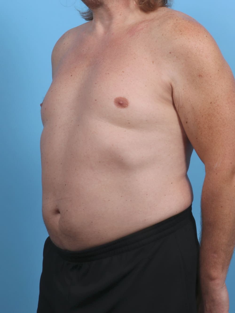Liposuction case #4569 after, image 2