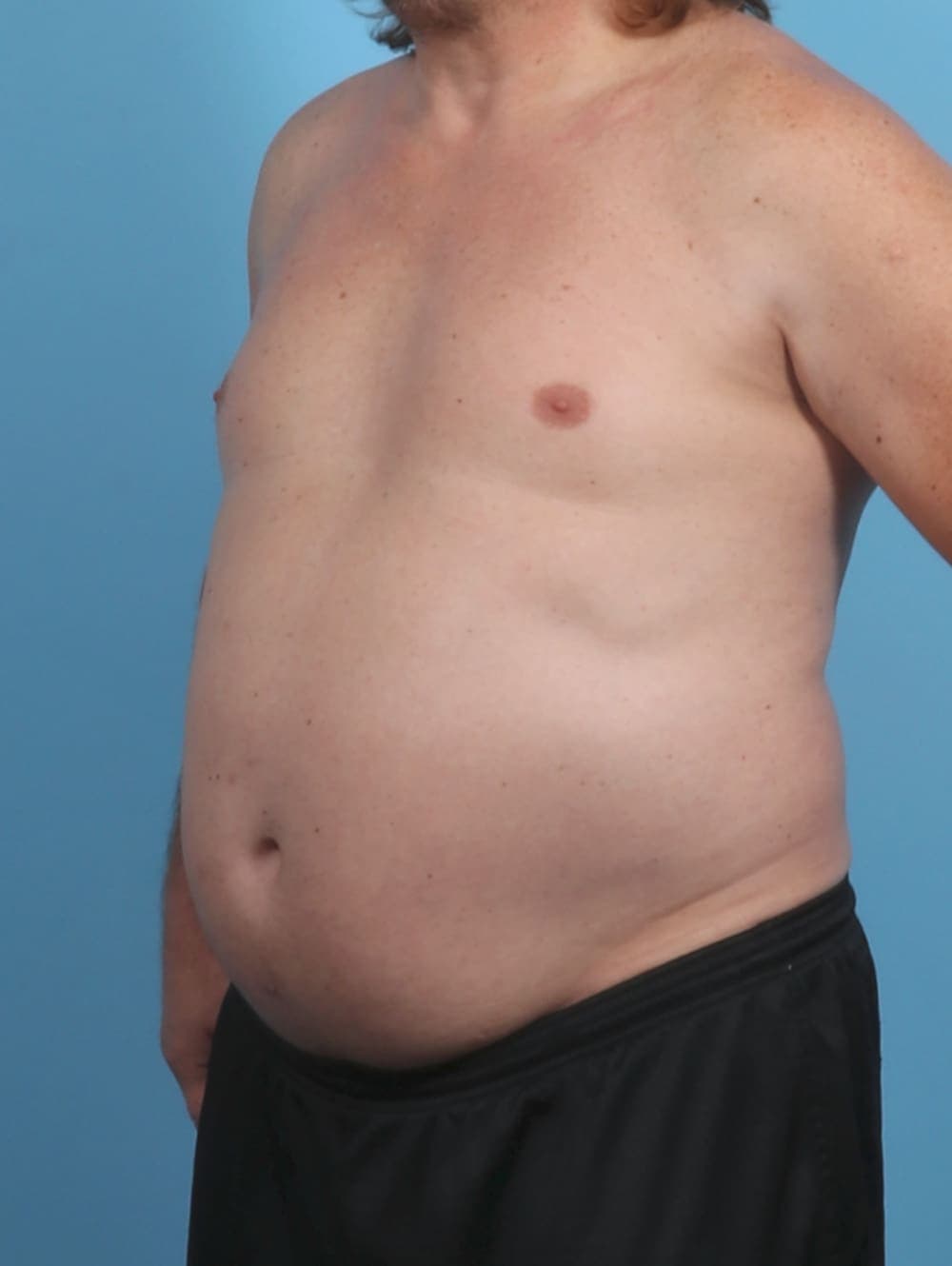Liposuction case #4569 before, image 2