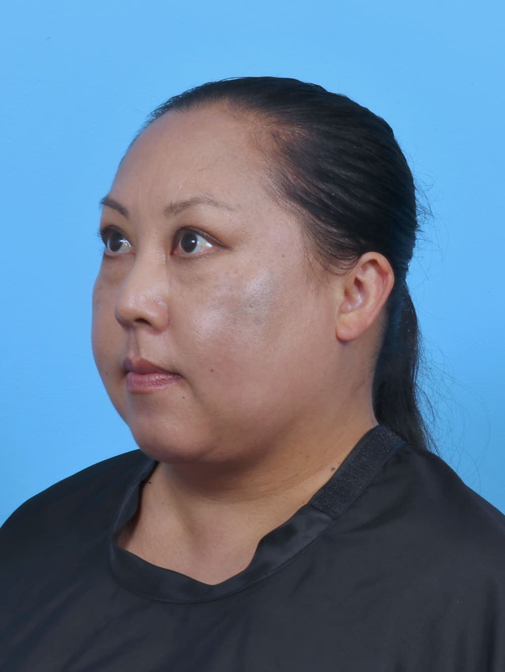 Liposuction case #5644 after, image 2