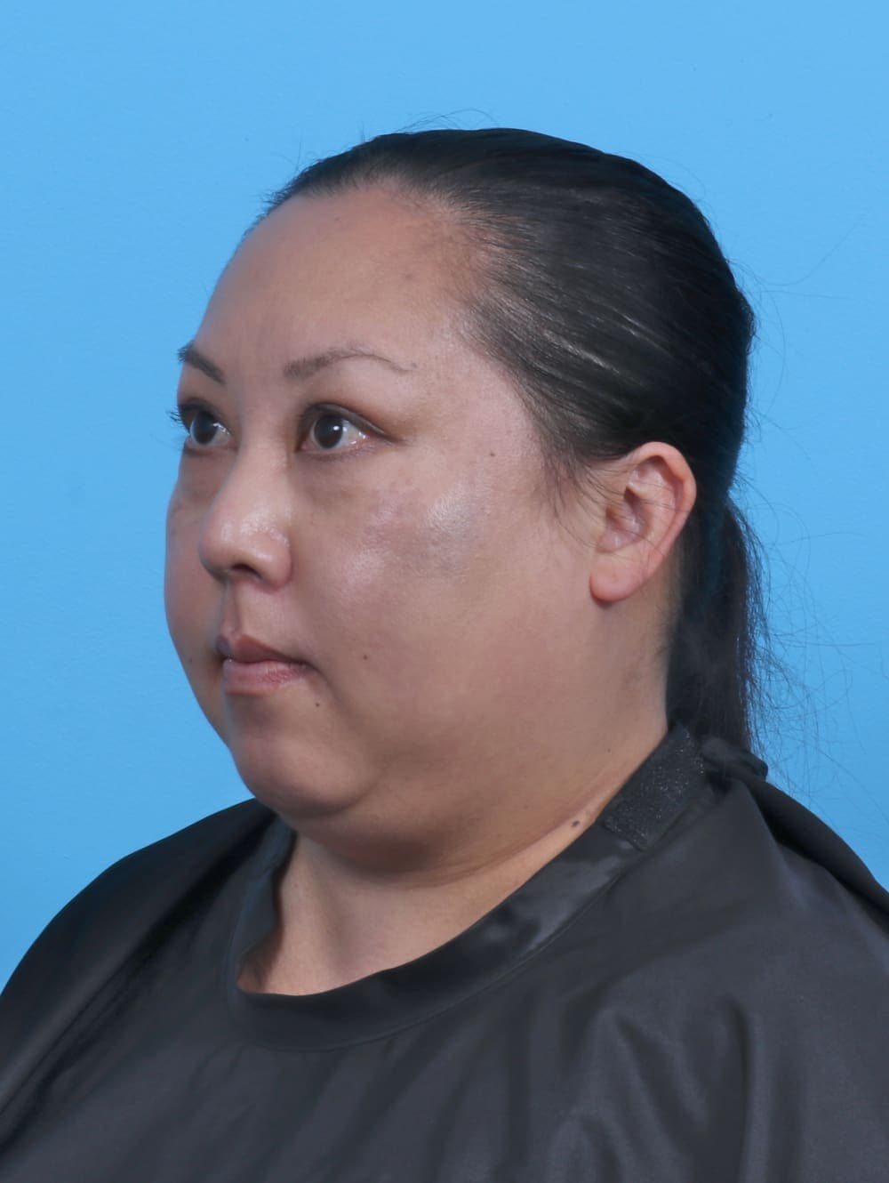 Liposuction case #5644 before, image 2