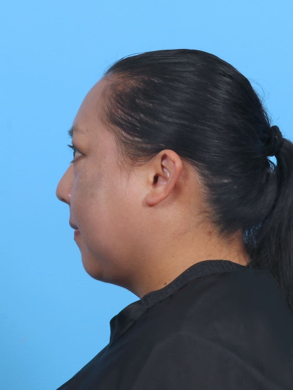 Liposuction case #5644 after, image 3