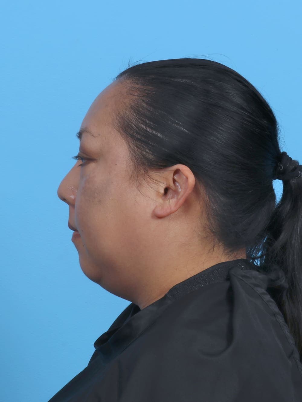 Liposuction case #5644 before, image 3