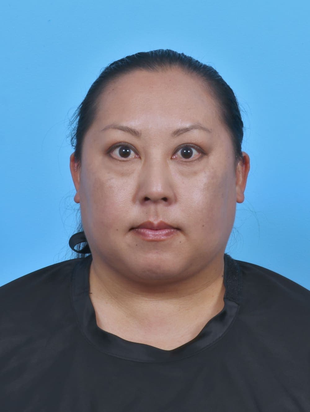 Liposuction case #5644 after, image 1