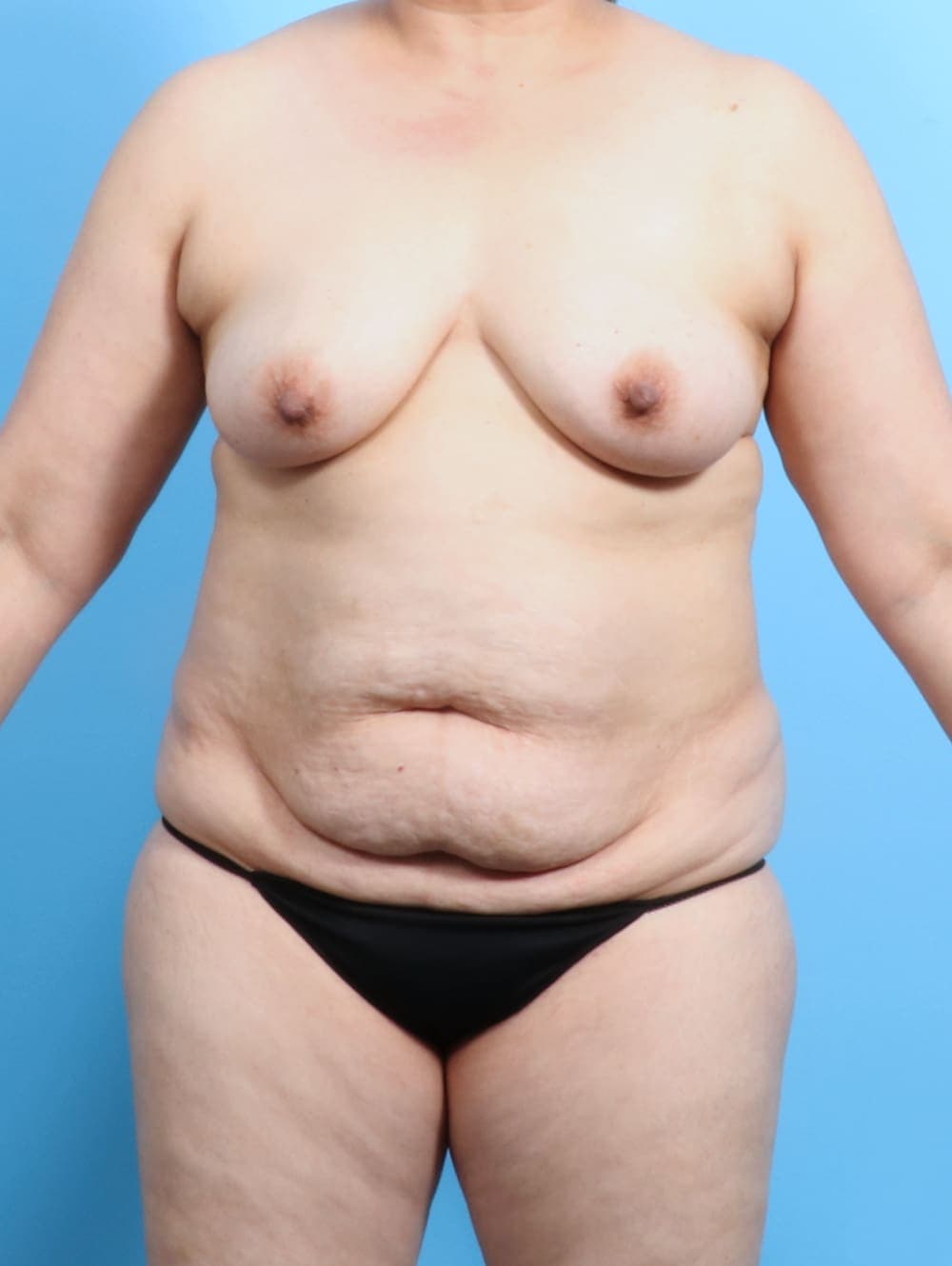 Breast Lift with Implants case #2577 before, image 1