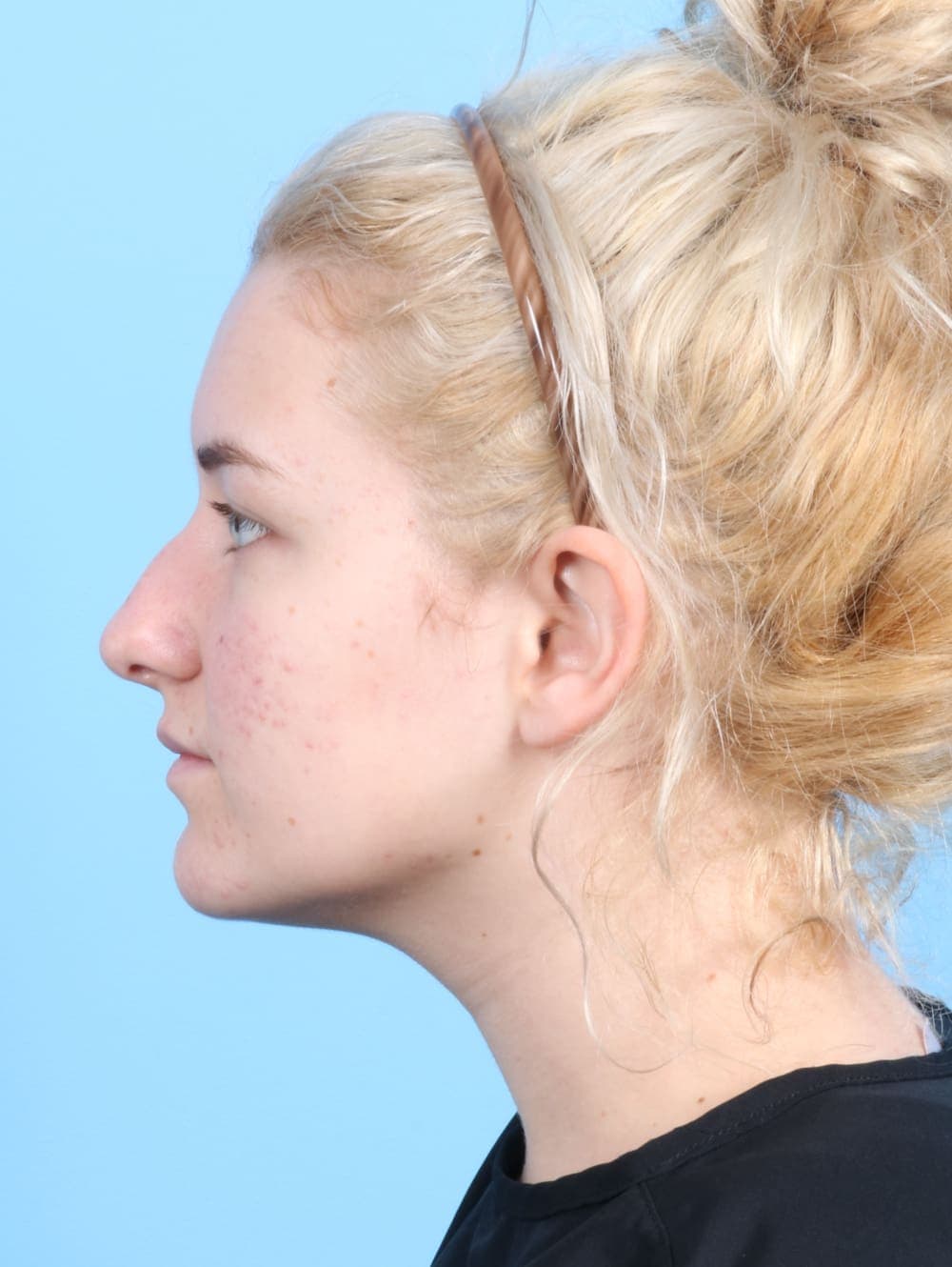 Rhinoplasty case #2585 before, image 1