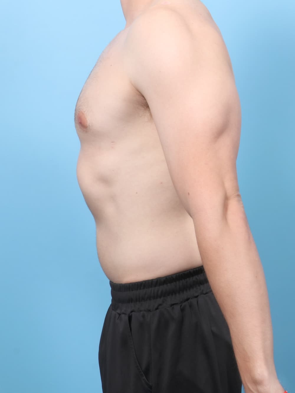 Male Breast Reduction case #8988 after, image 3