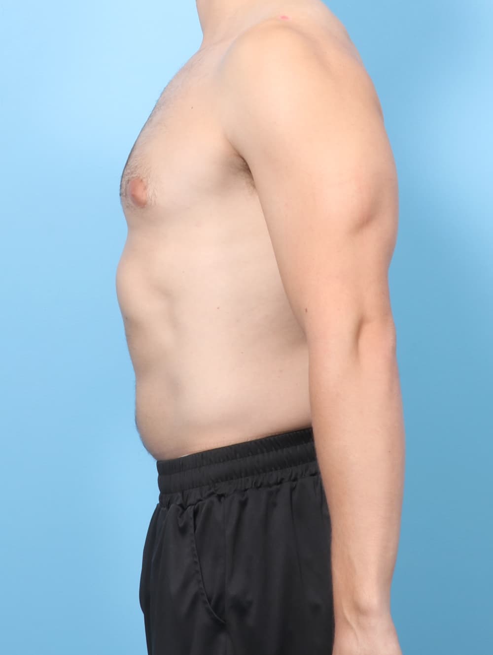 Male Breast Reduction case #8988 before, image 3