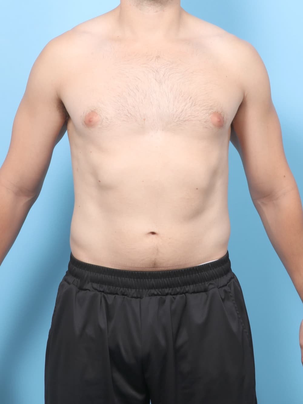 Male Breast Reduction case #8988 before, image 1