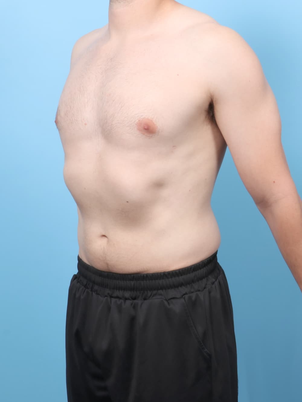 Male Breast Reduction case #8988 after, image 2