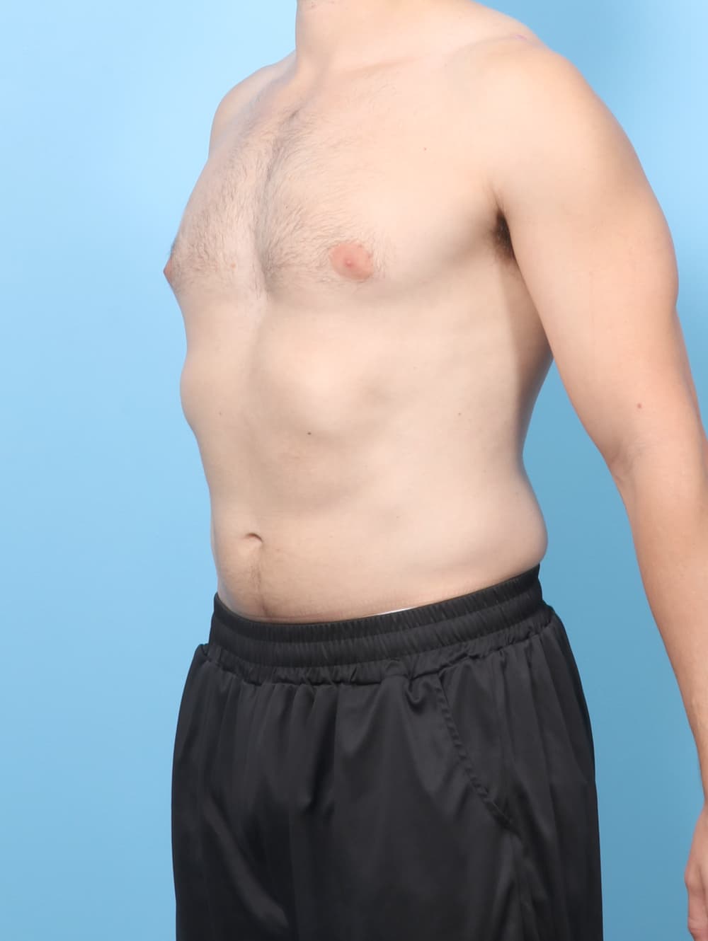 Male Breast Reduction case #8988 before, image 2