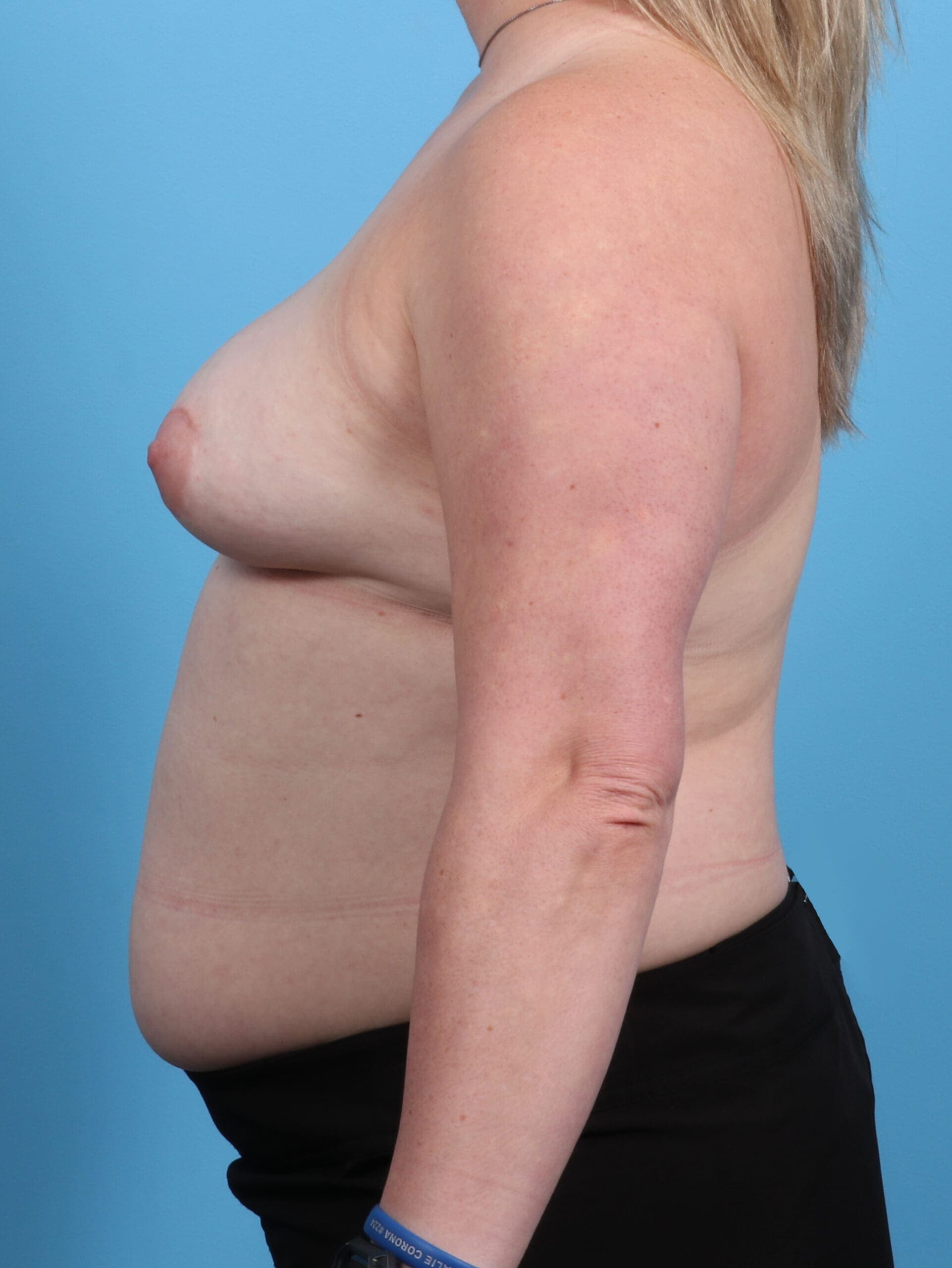 Breast Implant Revision case #3890 before, image 3