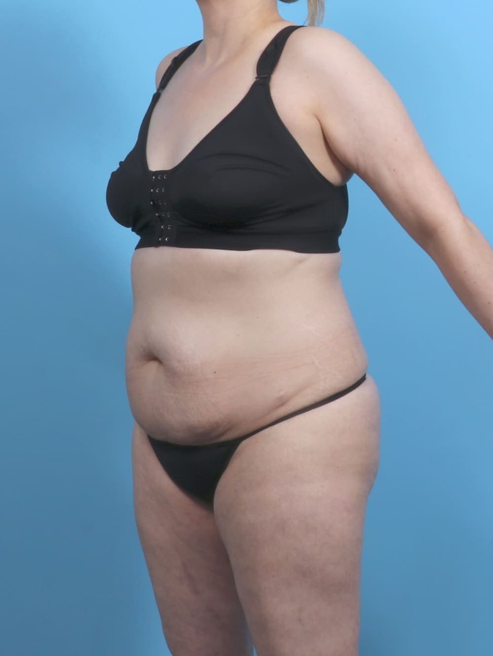 Tummy Tuck case #5552 before, image 2