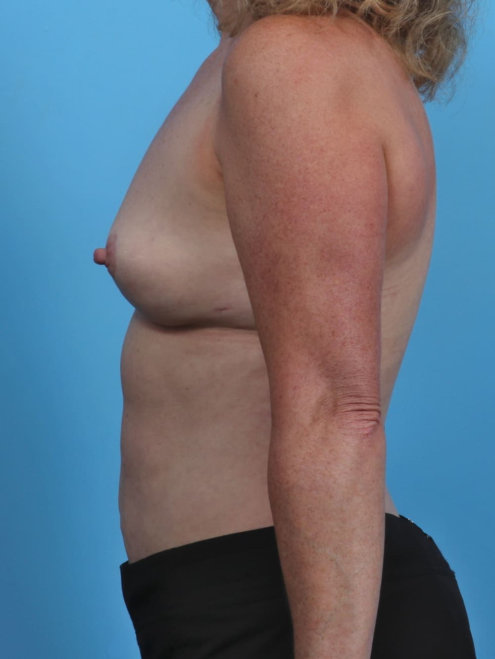 Breast Implant Removal with Lift case #3709 after, image 3