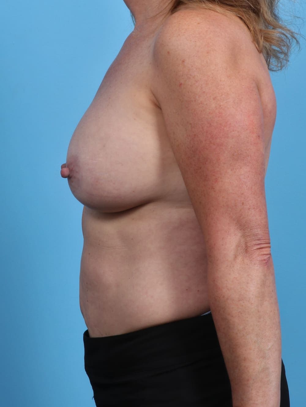 Breast Implant Removal with Lift case #3709 before, image 3