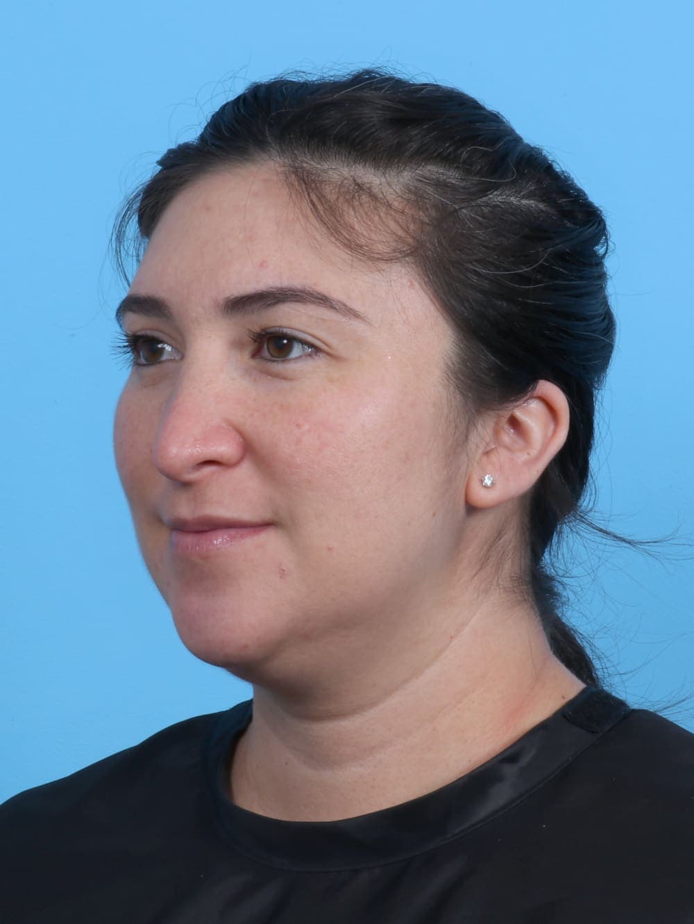 Rhinoplasty case #4155 after, image 3