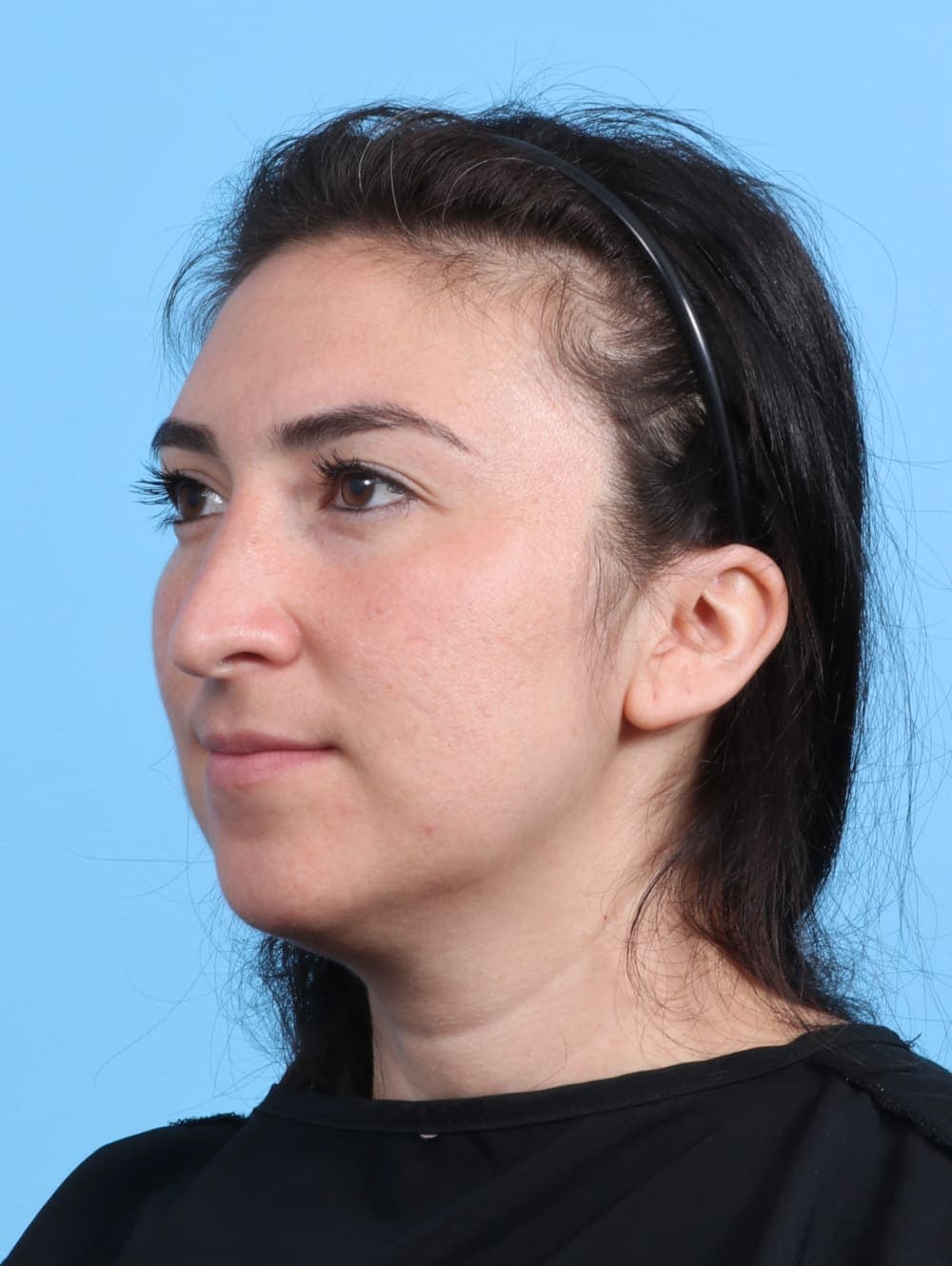 Rhinoplasty case #4155 before, image 3