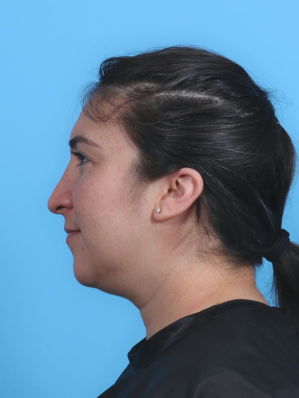 Rhinoplasty case #4155 after