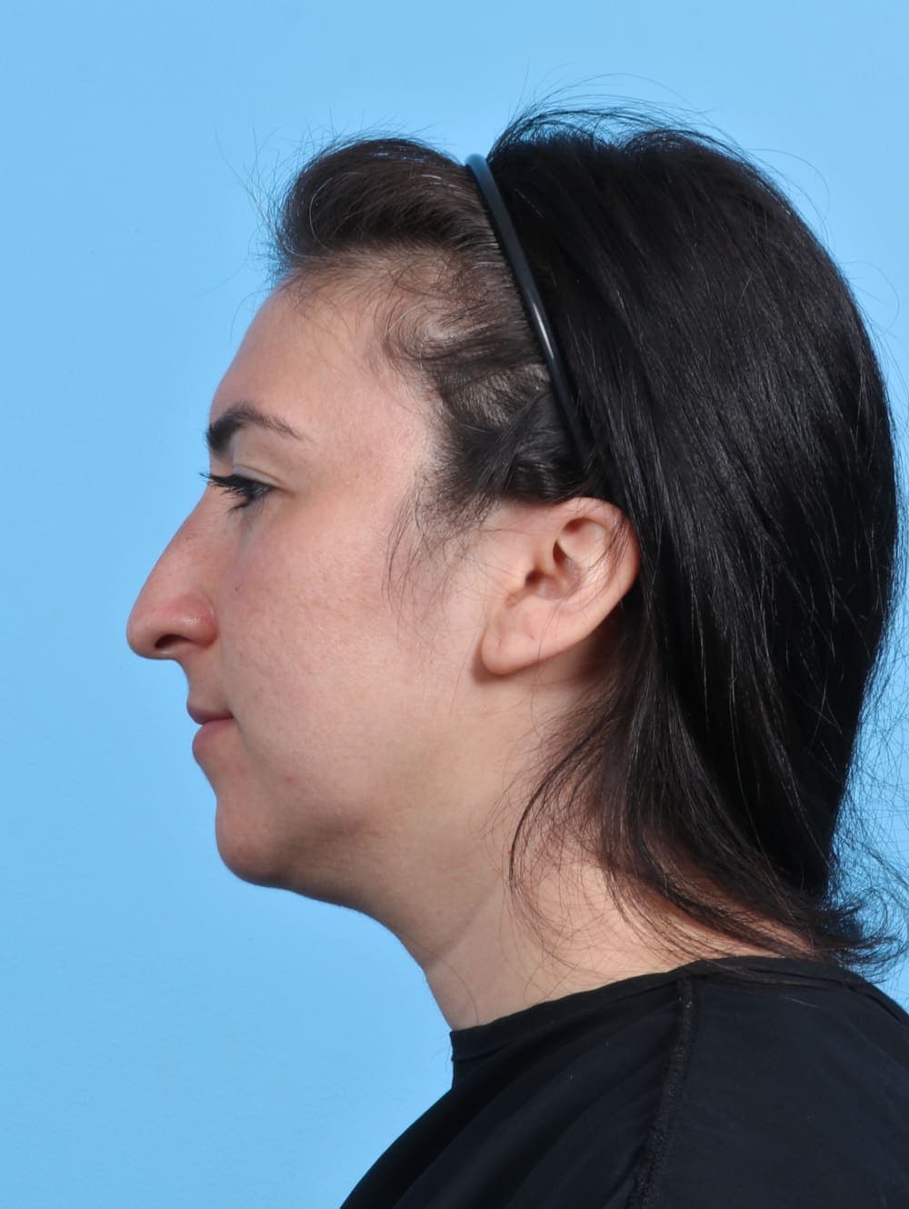 Rhinoplasty case #4155 before